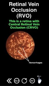 Retinal Vein Occlusion (RVO)